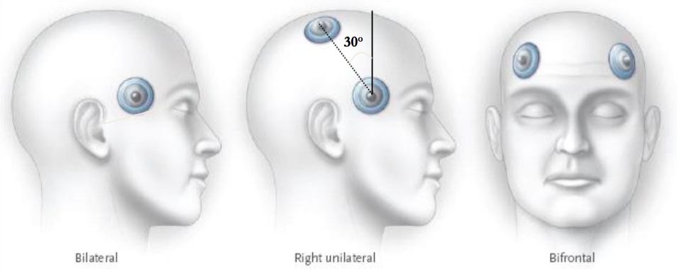 How Electroconvulsive Therapy Works