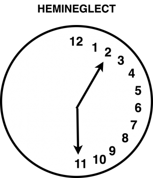 Hemineglect: This drawing shows the crowding of numbers all on one half of the clock. Individuals may not be aware of this crowding and believe they have drawn in the full circle of numbers.