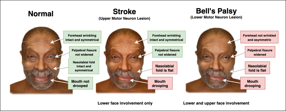 Upper Motor Neuron Lesion (Stroke) vs. Lower Motor Neuron Lesion (Bell's Palsy)