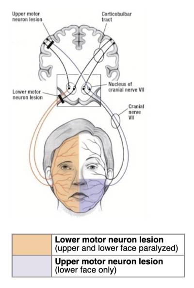 Upper Motor Neuron Lesion vs. Lower Motor Neuron Lesion