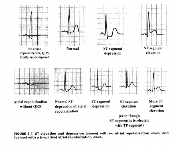 The ECG In Acute MI, Stephen W. Smith, MD